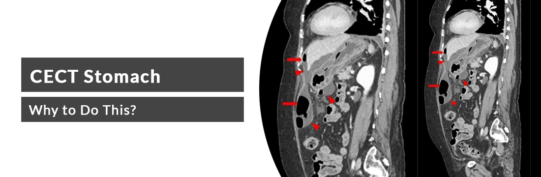 CECT Stomach: Why to Do This?